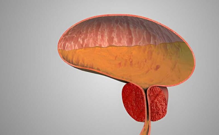 Best Natural Remedies for Slow Urine Flow-Enlarged Prostate